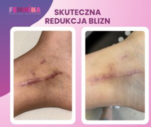 Laser frakcyjny – mała rewolucja w regeneracji skóry