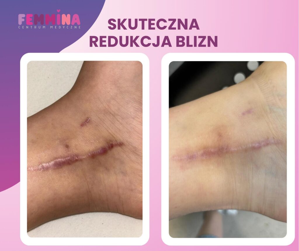 Laser frakcyjny – mała rewolucja w regeneracji skóry